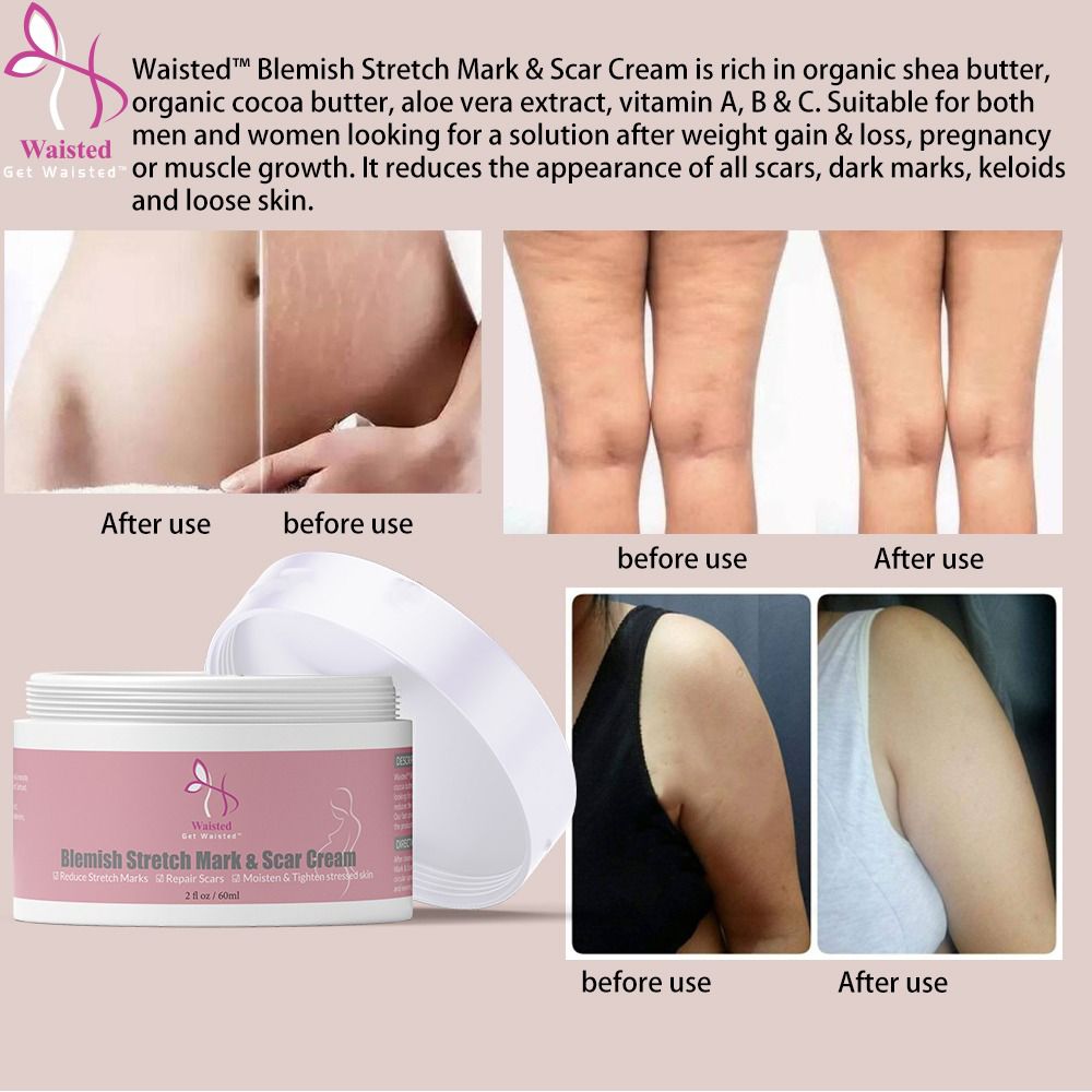 Blemish Stretch Mark & Scar Cream