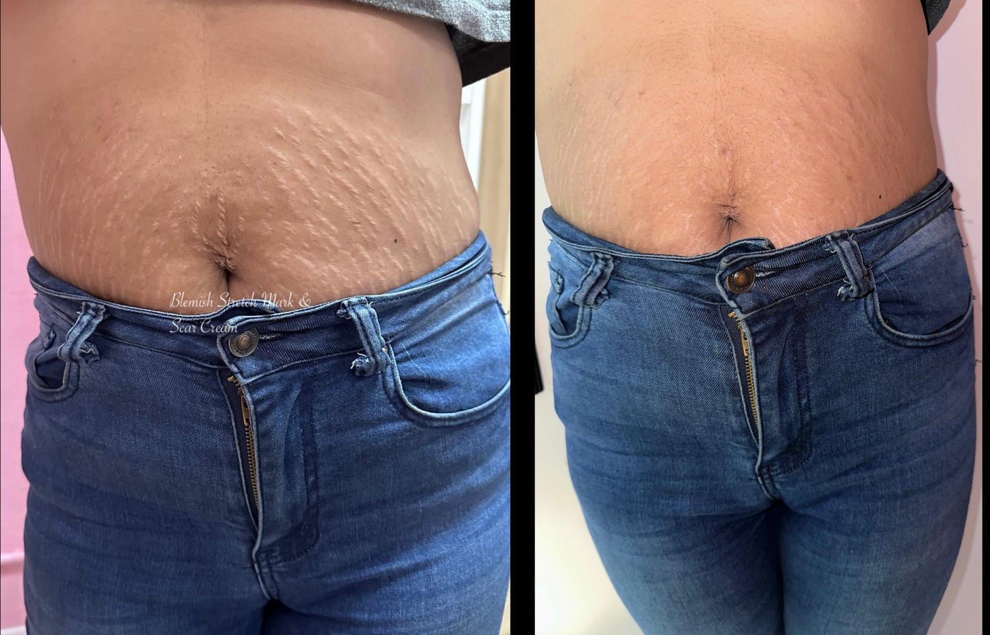 Blemish Stretch Mark & Scar Cream