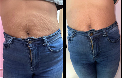 Blemish Stretch Mark & Scar Cream